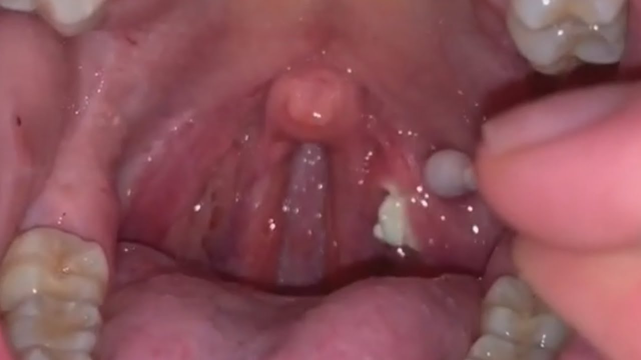 Home Remedies for Tonsil Stones